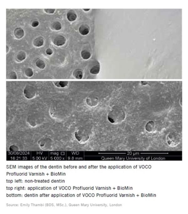 SEM image of the dentin before and after the application of VOCO Profluorid Varnish + BioMin